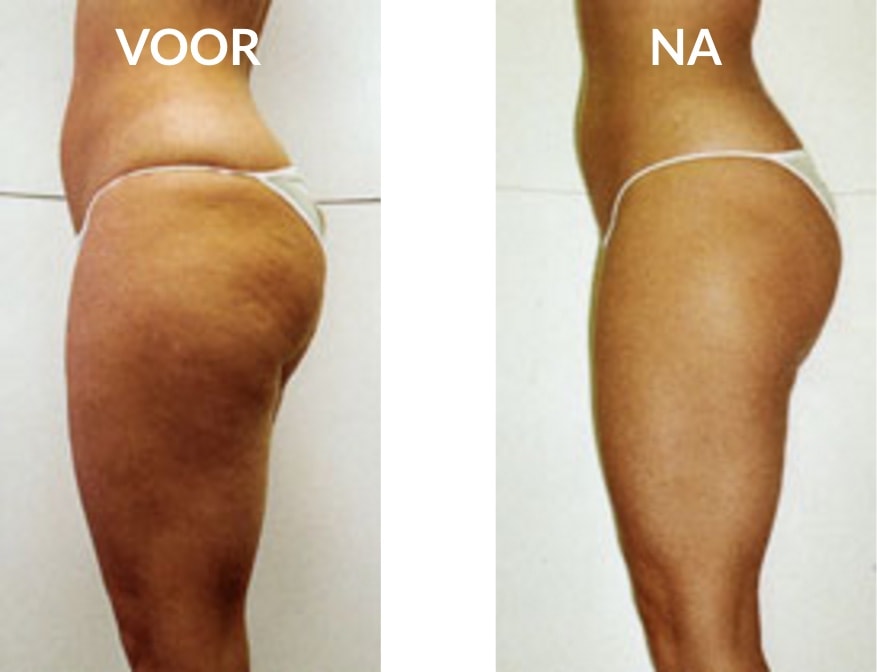 Cellulitis behandeling voor en na